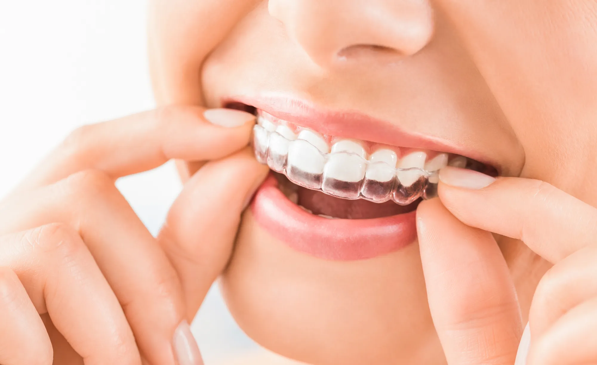 Allineatore trasparente Invisalign